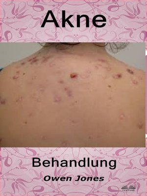 cover image of Akne-Behandlung